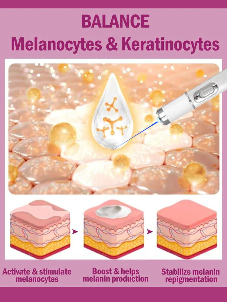 Efficient laser technology to quickly improve vitiligo