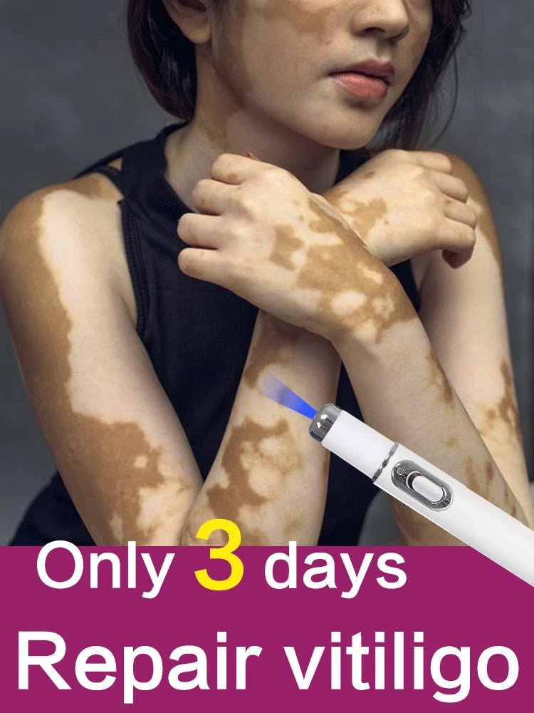 Efficient laser technology to quickly improve vitiligo
