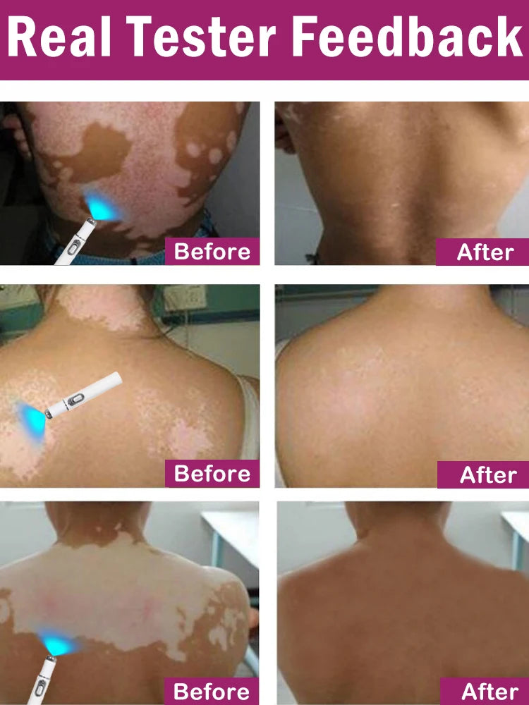Efficient laser technology to quickly improve vitiligo